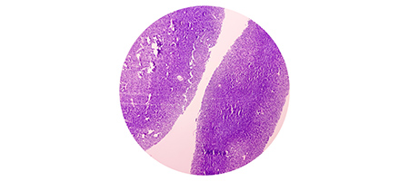 Sarcoma Timeline Image